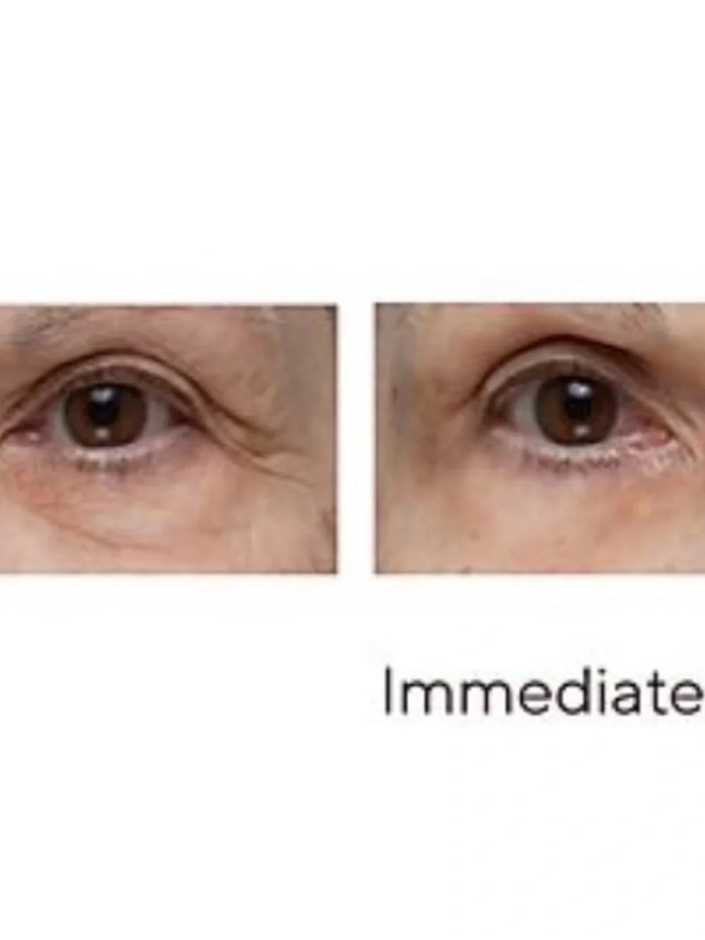 Peter Thomas Roth Instant Eye Tightener – Black Tube